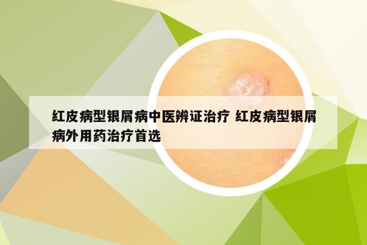 红皮病型银屑病中医辨证治疗 红皮病型银屑病外用药治疗首选