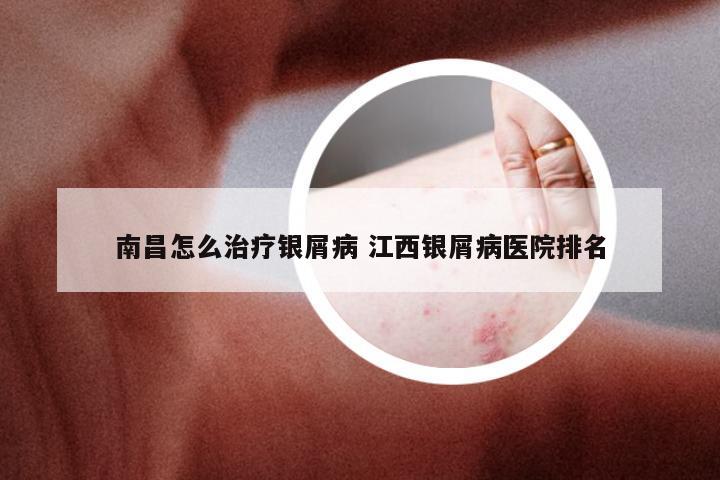 南昌怎么治疗银屑病 江西银屑病医院排名