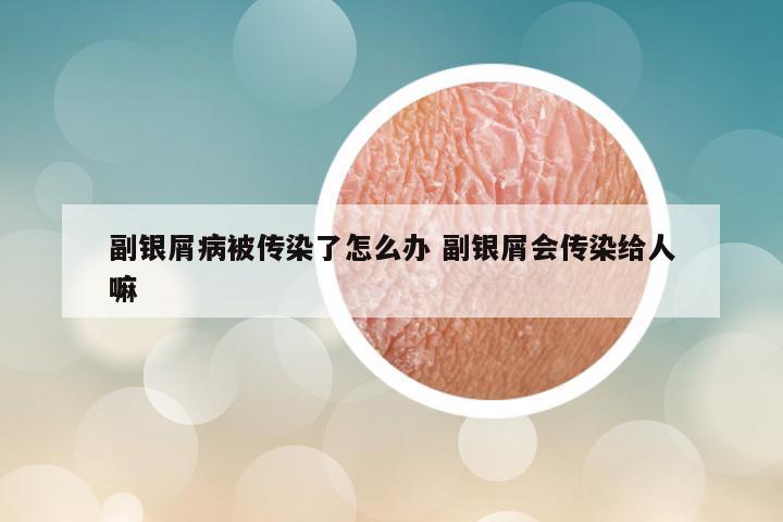 副银屑病被传染了怎么办 副银屑会传染给人嘛