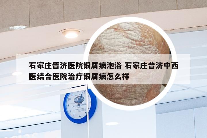 石家庄晋济医院银屑病泡浴 石家庄普济中西医结合医院治疗银屑病怎么样