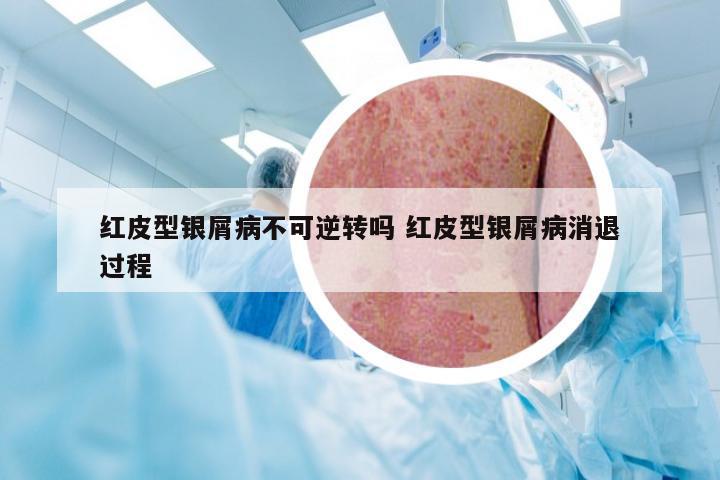 红皮型银屑病不可逆转吗 红皮型银屑病消退过程