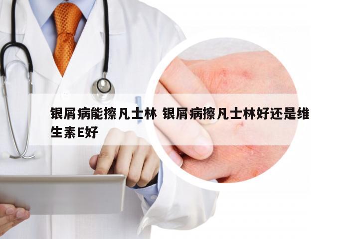 银屑病能擦凡士林 银屑病擦凡士林好还是维生素E好