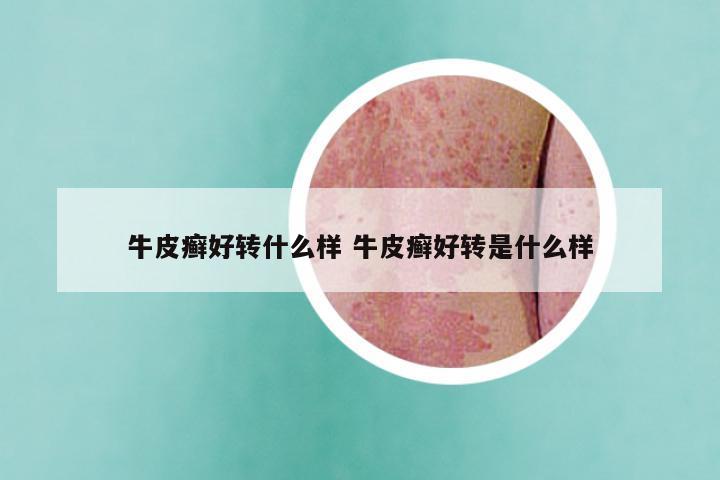 牛皮癣好转什么样 牛皮癣好转是什么样
