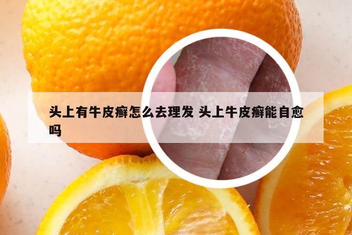 头上有牛皮癣怎么去理发 头上牛皮癣能自愈吗