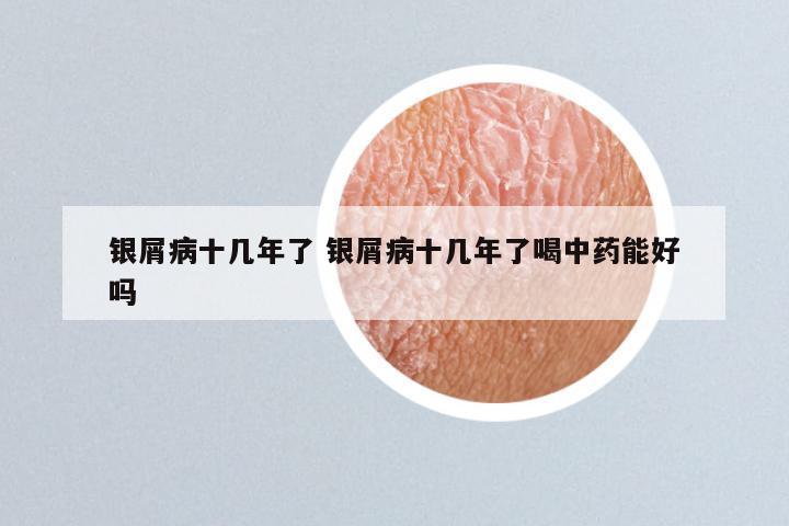 银屑病十几年了 银屑病十几年了喝中药能好吗