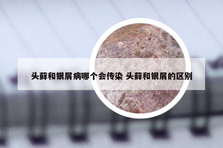 头藓和银屑病哪个会传染 头藓和银屑的区别
