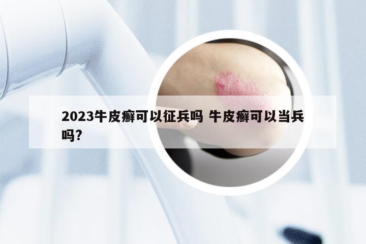 2023牛皮癣可以征兵吗 牛皮癣可以当兵吗?