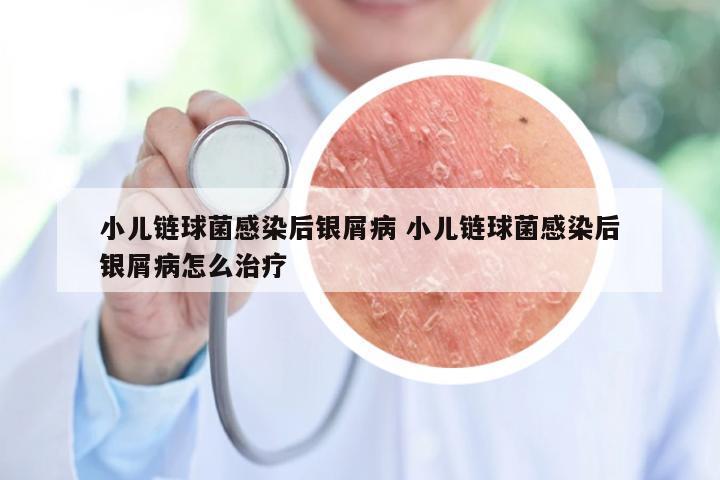 小儿链球菌感染后银屑病 小儿链球菌感染后银屑病怎么治疗