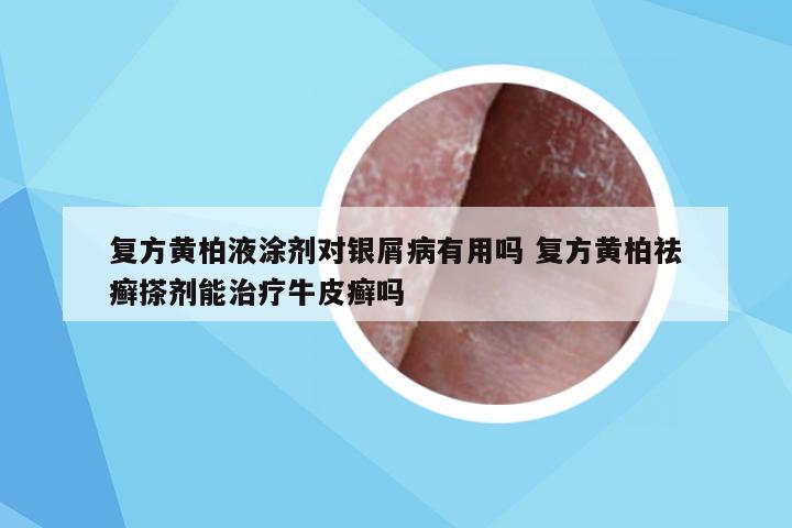 复方黄柏液涂剂对银屑病有用吗 复方黄柏祛癣搽剂能治疗牛皮癣吗