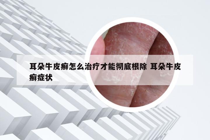 耳朵牛皮癣怎么治疗才能彻底根除 耳朵牛皮癣症状