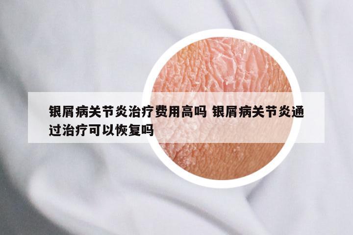 银屑病关节炎治疗费用高吗 银屑病关节炎通过治疗可以恢复吗