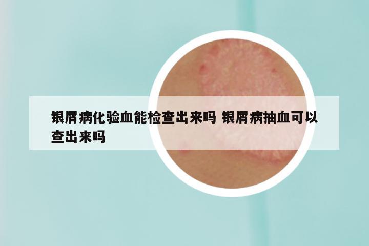 银屑病化验血能检查出来吗 银屑病抽血可以查出来吗