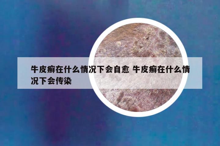 牛皮癣在什么情况下会自愈 牛皮癣在什么情况下会传染