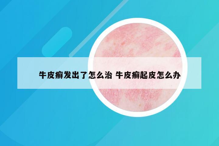 牛皮癣发出了怎么治 牛皮癣起皮怎么办