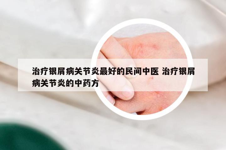 治疗银屑病关节炎最好的民间中医 治疗银屑病关节炎的中药方