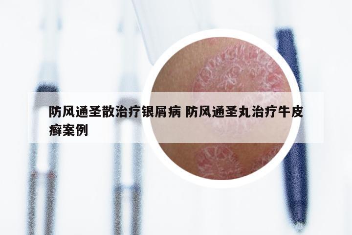 防风通圣散治疗银屑病 防风通圣丸治疗牛皮癣案例