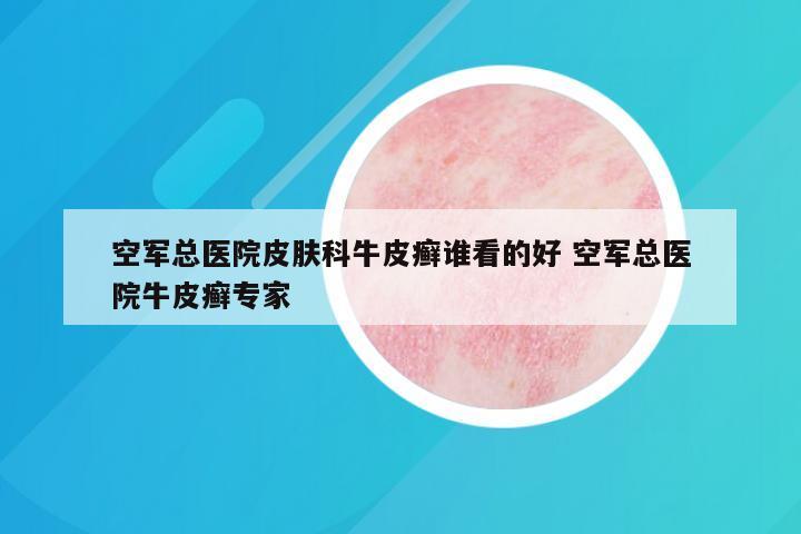 空军总医院皮肤科牛皮癣谁看的好 空军总医院牛皮癣专家