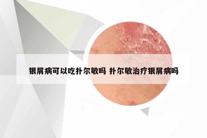 银屑病可以吃扑尔敏吗 扑尔敏治疗银屑病吗