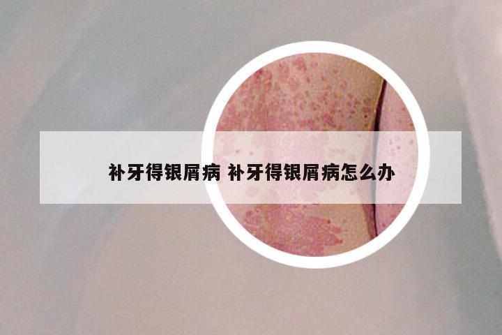 补牙得银屑病 补牙得银屑病怎么办