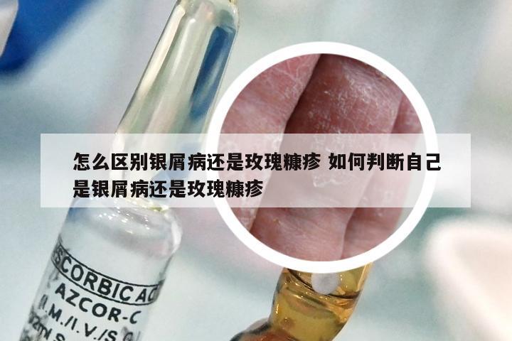 怎么区别银屑病还是玫瑰糠疹 如何判断自己是银屑病还是玫瑰糠疹
