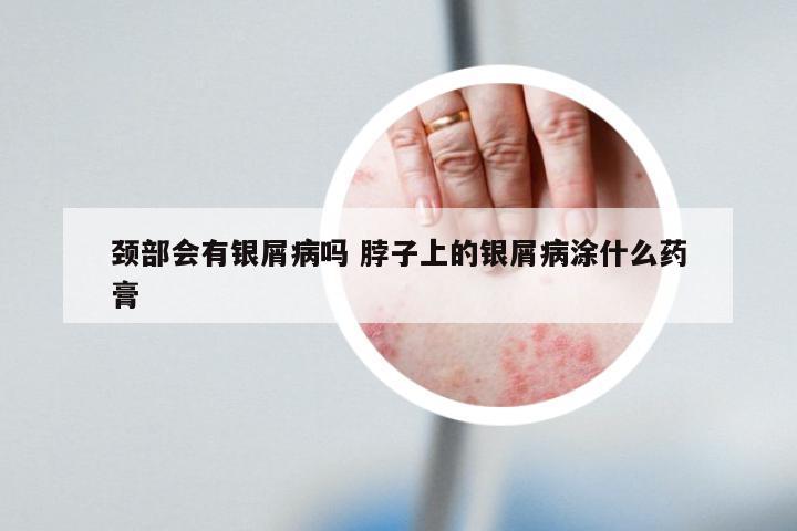 颈部会有银屑病吗 脖子上的银屑病涂什么药膏