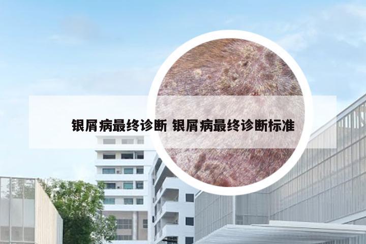 银屑病最终诊断 银屑病最终诊断标准