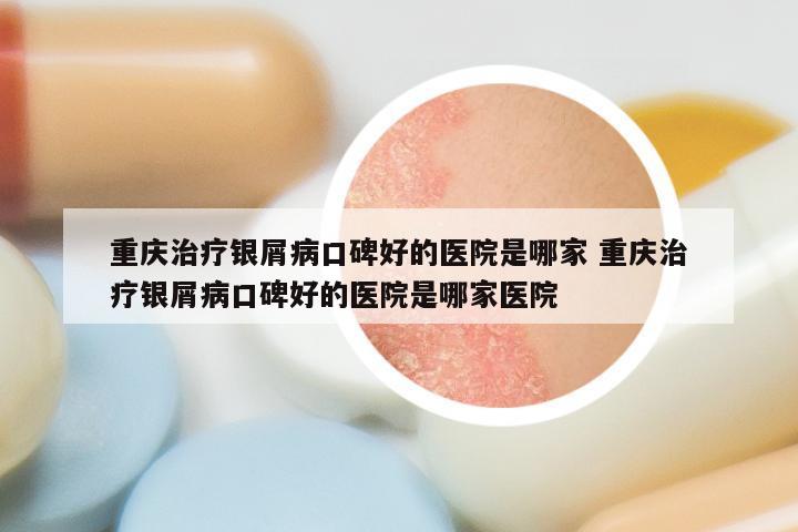 重庆治疗银屑病口碑好的医院是哪家 重庆治疗银屑病口碑好的医院是哪家医院