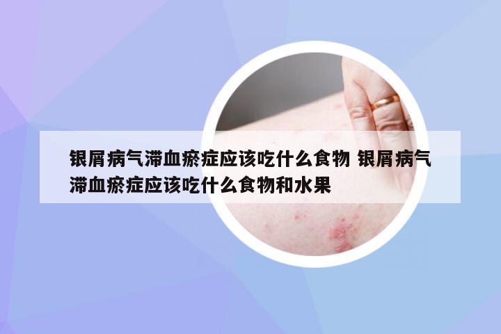 银屑病气滞血瘀症应该吃什么食物 银屑病气滞血瘀症应该吃什么食物和水果