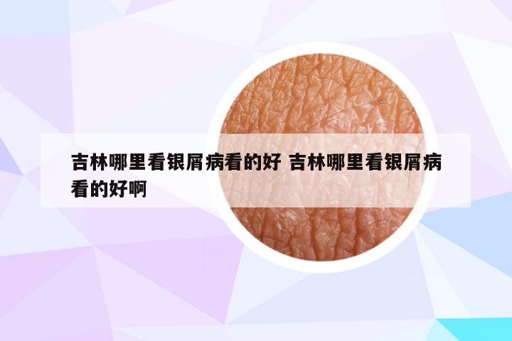 吉林哪里看银屑病看的好 吉林哪里看银屑病看的好啊