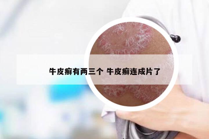 牛皮癣有两三个 牛皮癣连成片了