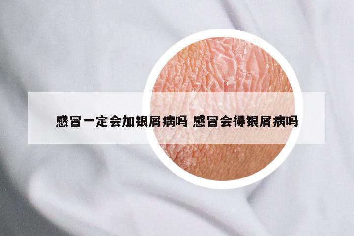 感冒一定会加银屑病吗 感冒会得银屑病吗