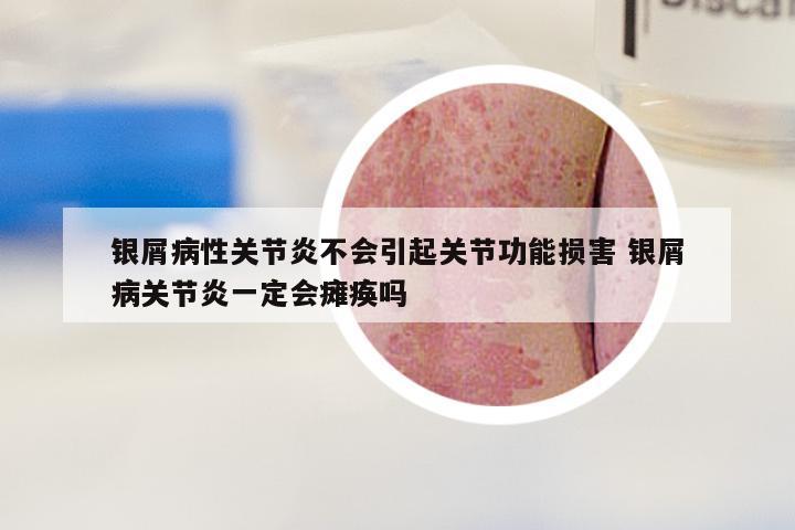 银屑病性关节炎不会引起关节功能损害 银屑病关节炎一定会瘫痪吗