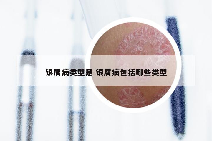 银屑病类型是 银屑病包括哪些类型