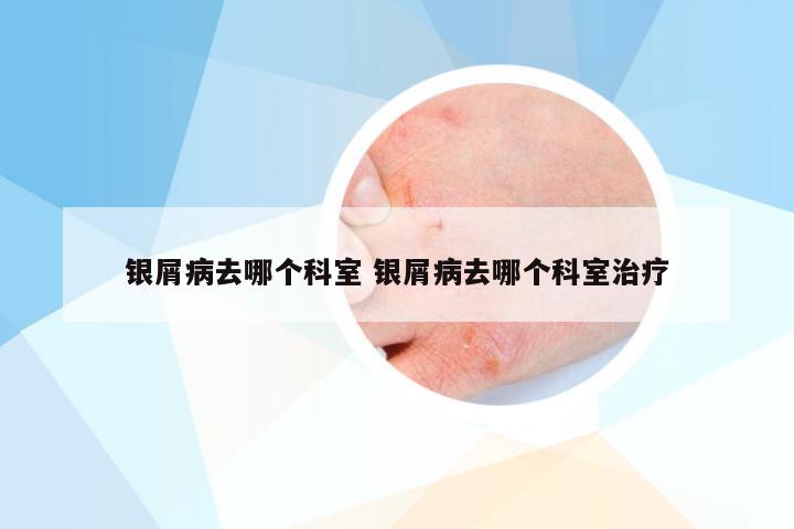 银屑病去哪个科室 银屑病去哪个科室治疗