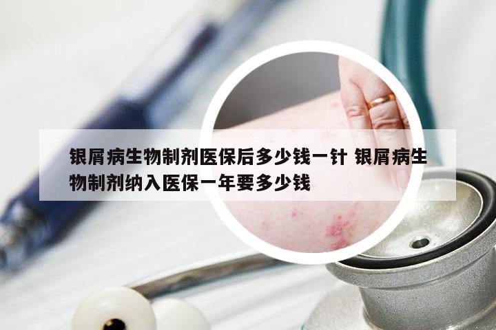 银屑病生物制剂医保后多少钱一针 银屑病生物制剂纳入医保一年要多少钱