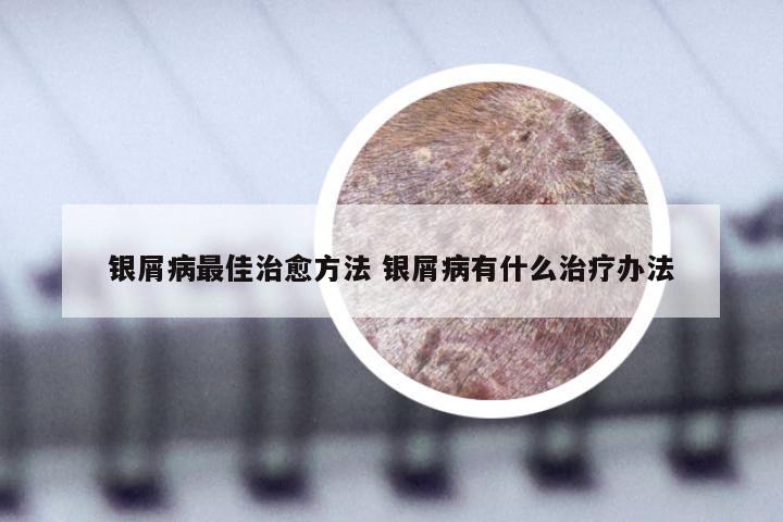 银屑病最佳治愈方法 银屑病有什么治疗办法