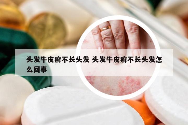头发牛皮癣不长头发 头发牛皮癣不长头发怎么回事