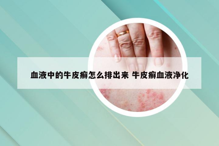 血液中的牛皮癣怎么排出来 牛皮癣血液净化