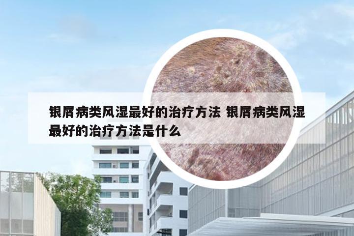 银屑病类风湿最好的治疗方法 银屑病类风湿最好的治疗方法是什么