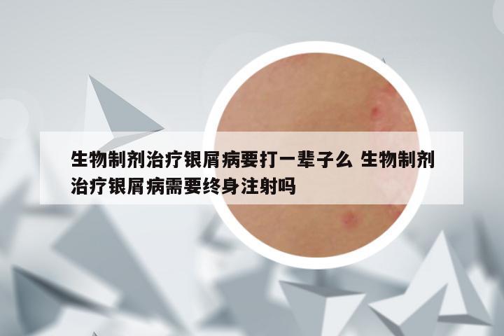 生物制剂治疗银屑病要打一辈子么 生物制剂治疗银屑病需要终身注射吗