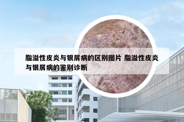 脂溢性皮炎与银屑病的区别图片 脂溢性皮炎与银屑病的鉴别诊断