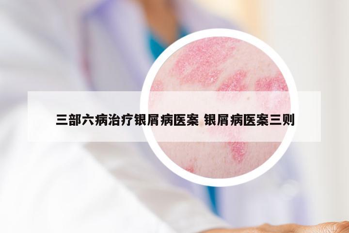 三部六病治疗银屑病医案 银屑病医案三则