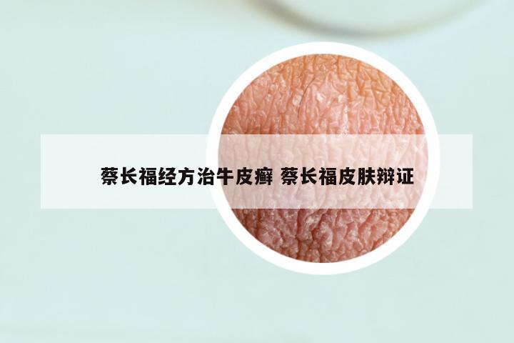 蔡长福经方治牛皮癣 蔡长福皮肤辩证