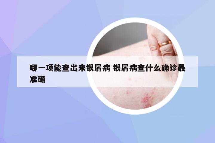 哪一项能查出来银屑病 银屑病查什么确诊最准确
