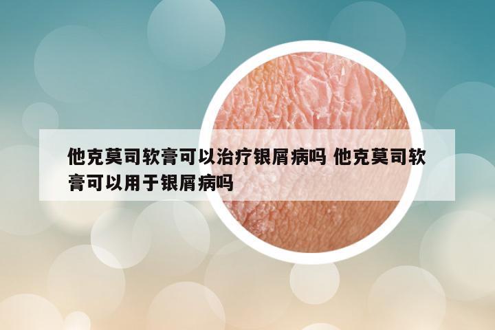 他克莫司软膏可以治疗银屑病吗 他克莫司软膏可以用于银屑病吗