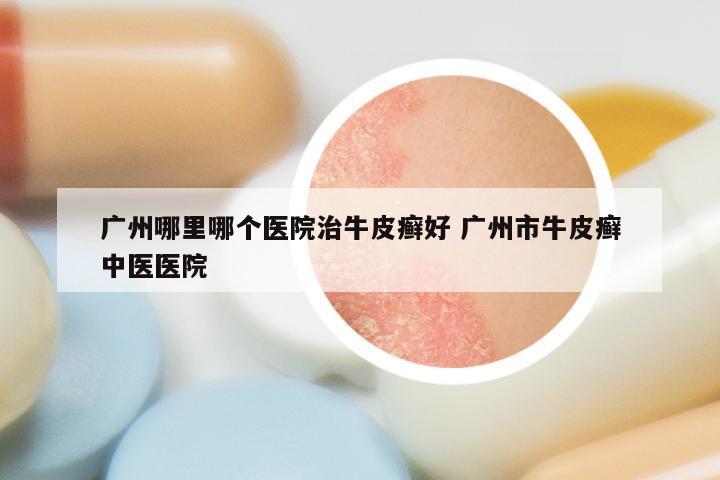 广州哪里哪个医院治牛皮癣好 广州市牛皮癣中医医院