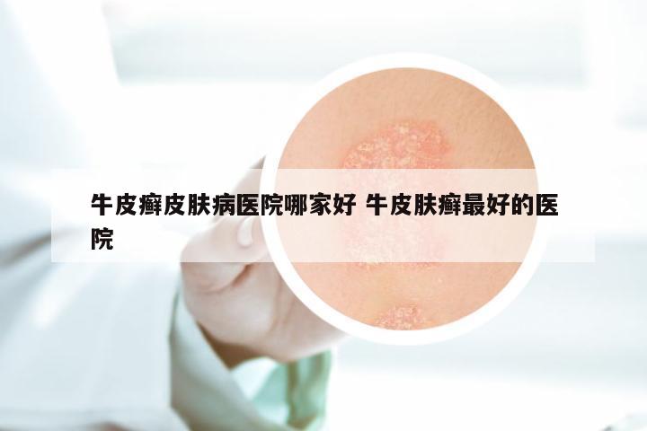 牛皮癣皮肤病医院哪家好 牛皮肤癣最好的医院