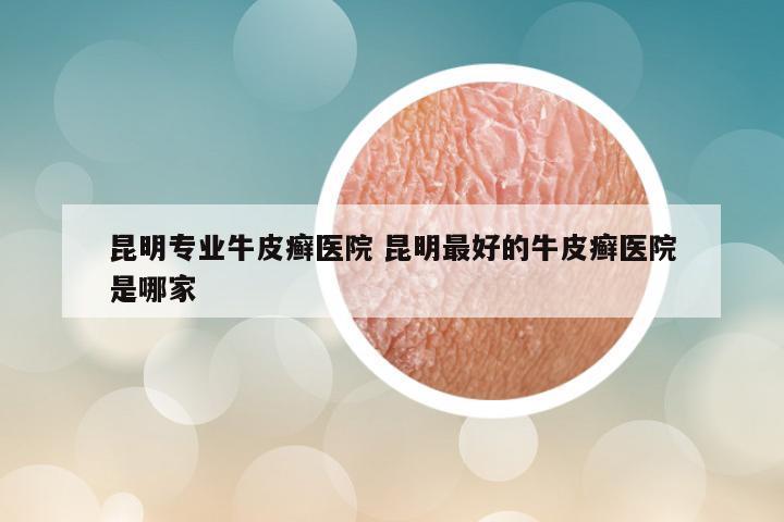 昆明专业牛皮癣医院 昆明最好的牛皮癣医院是哪家