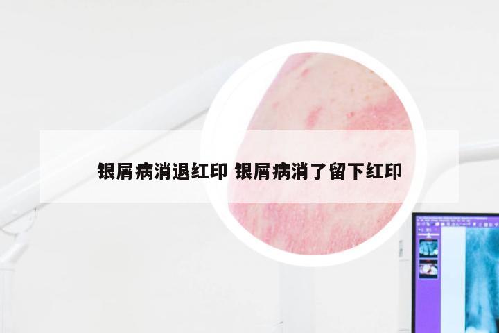 银屑病消退红印 银屑病消了留下红印
