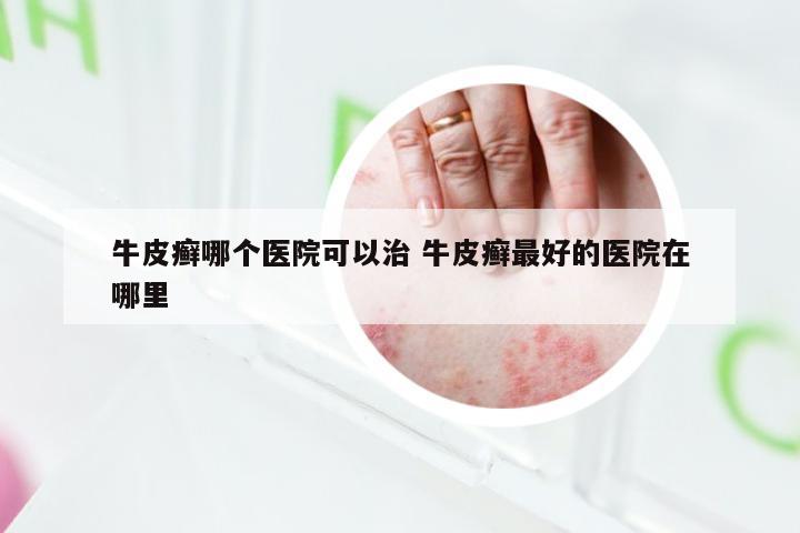 牛皮癣哪个医院可以治 牛皮癣最好的医院在哪里